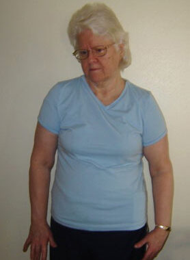 Carole showing her dystonia in 2012. Neck pulled to right side. Right shoulder higher than left. Crooked fingers on right hand.
